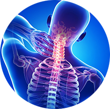 Cervical-Spondylitis