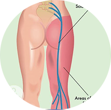 Sciatica